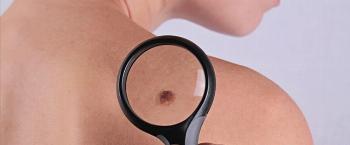 Melanoma: Lesões podem ser sinal de câncer de pele 