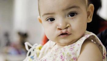 Hamburgueria faz parceria com ONG em prol das crianças com fissura labiopalatal 