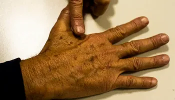 Sesa alerta sobre cuidados necessários para evitar o câncer de pele 