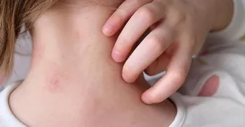 Anvisa aprova uso de medicamentos para tratamento de lúpus e esclerose múltipla 