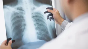 Anvisa aprova medicamento para tratamento de câncer de pulmão avançado 