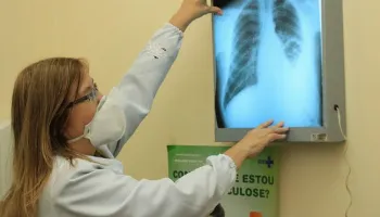 Novas diretrizes para tratamento da tuberculose são aprovadas pelo Conselho Nacional de Saúde 