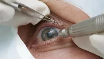Cirurgia que muda cor dos olhos é indicada apenas para pessoas cegas; entenda 