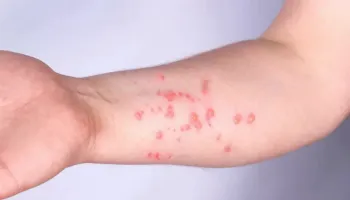 Brasil registra 88 casos de Mpox em 2026 