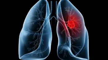 Entenda o que é adenocarcinoma pulmonar, câncer diagnosticado no Papa Leão XIV 