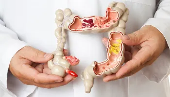 Cada vez mais comum, internações por câncer de intestino batem recorde no Brasil 