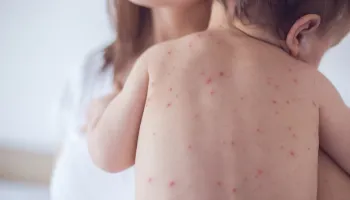 Casos de catapora aumentam na primavera, alerta infectologista; saiba como se proteger 
