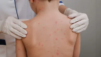 Conheça mitos e verdades sobre a meningite 