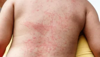 Sintomas da dengue: quando procurar atendimento médico? 