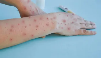 Número de casos de mpox no Brasil chega a 140 