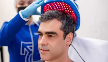 Mitos e verdades sobre a calvície e transplantes capilares 