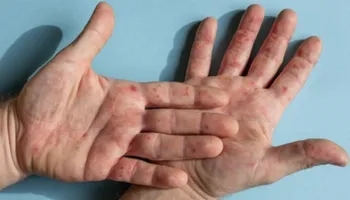 Secretaria de Saúde confirma 4º caso de monkeypox em Maringá 