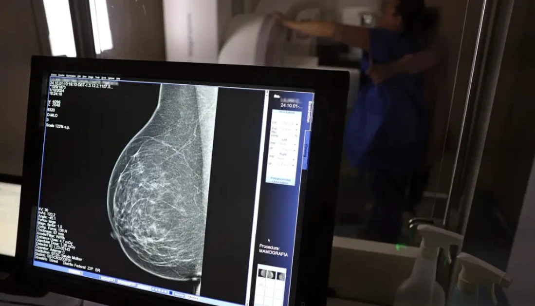 Uma em cada três mulheres com câncer de mama tem menos de 50 anos Uma em cada três mulheres com câncer de mama tem menos de 50 anos
