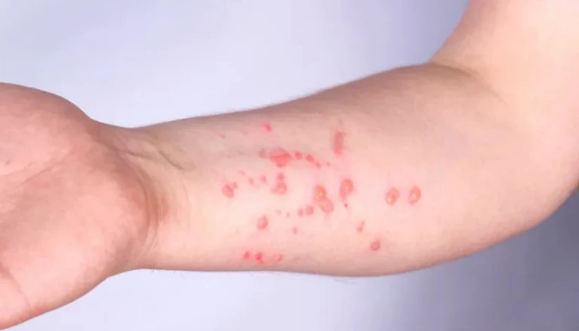Brasil registra 88 casos de Mpox em 2026
